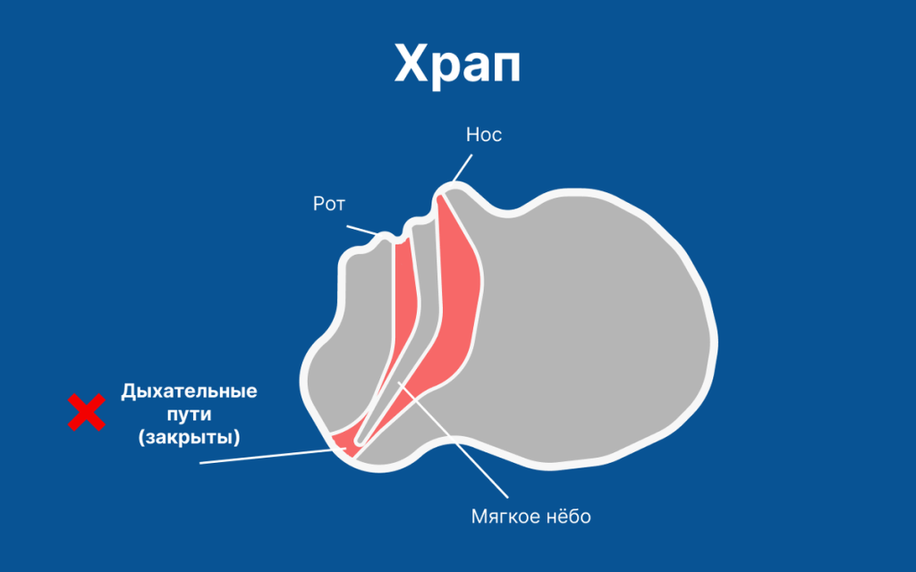 Как избавиться от храпа самостоятельно Как избавиться от храпа самостоятельно